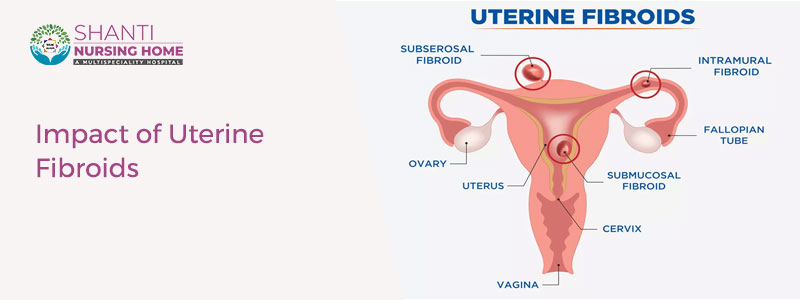 Impact of Uterine Fibroids
