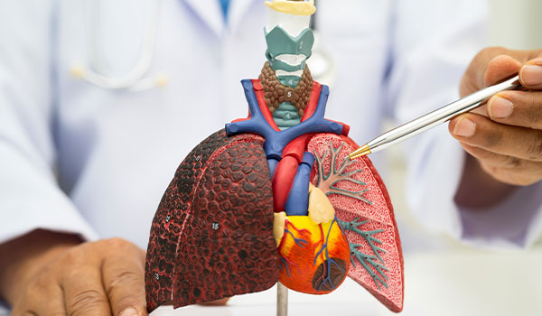 Organ failures